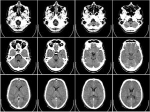 pixabay computer tomography ct radiography brain x ray 4x3 images