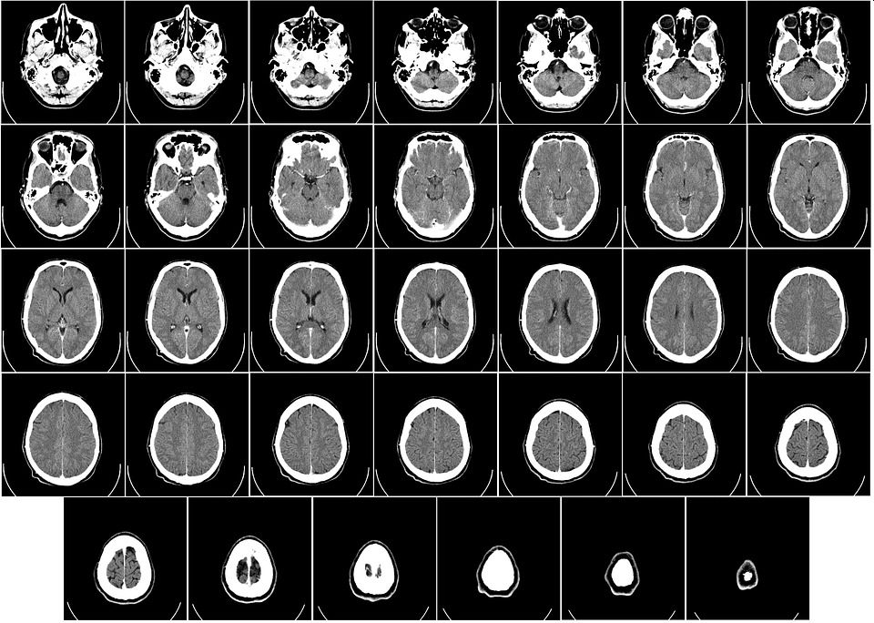 pixabay computer tomography ct radiography brain x ray